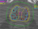 Optimization of HDR brachytherapy dose distributions using linear programming with penalty costs thumbnail
