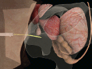 Interactive Simulation of Surgical Needle Insertion and Steering thumbnail
